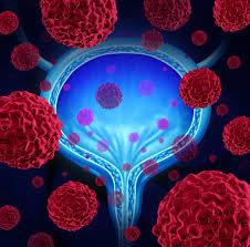 Urological Cancer
